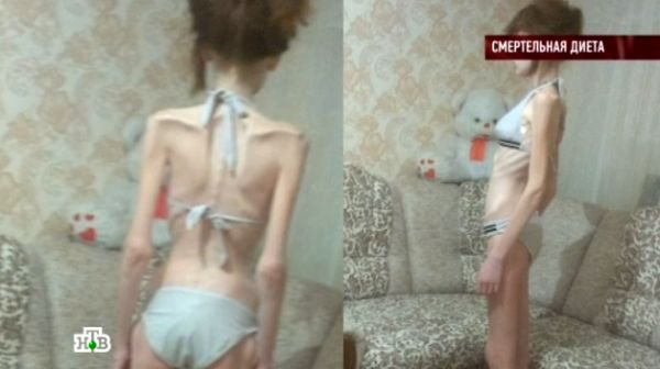 Семнадцатилетняя жительница Ростовской области скончалась от анорексии